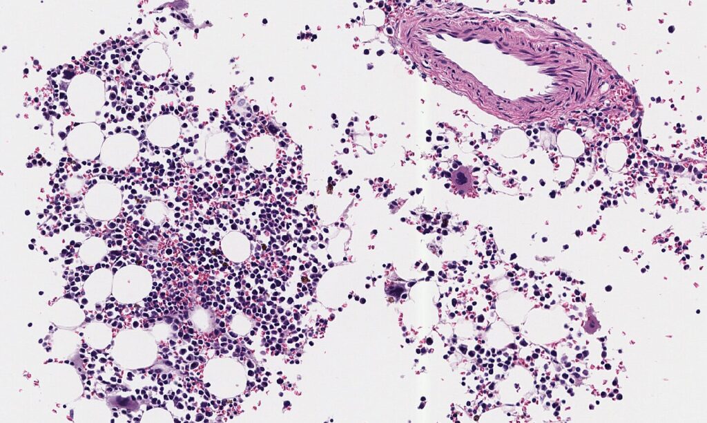 A photomicrograph of formalin fixed paraffin embedded bone marrow, demonstrating hematopoietic cells, megakaryocytes, and a vessel.